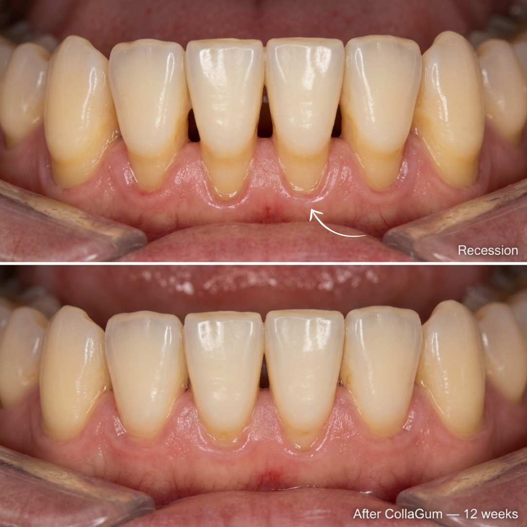 Restore Receding & Damaged Gums - CollaGum™