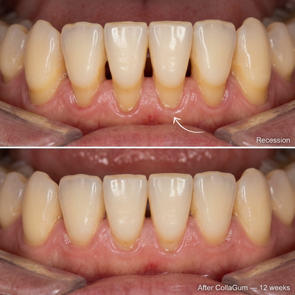 Restore Receding & Damaged Gums - CollaGum™