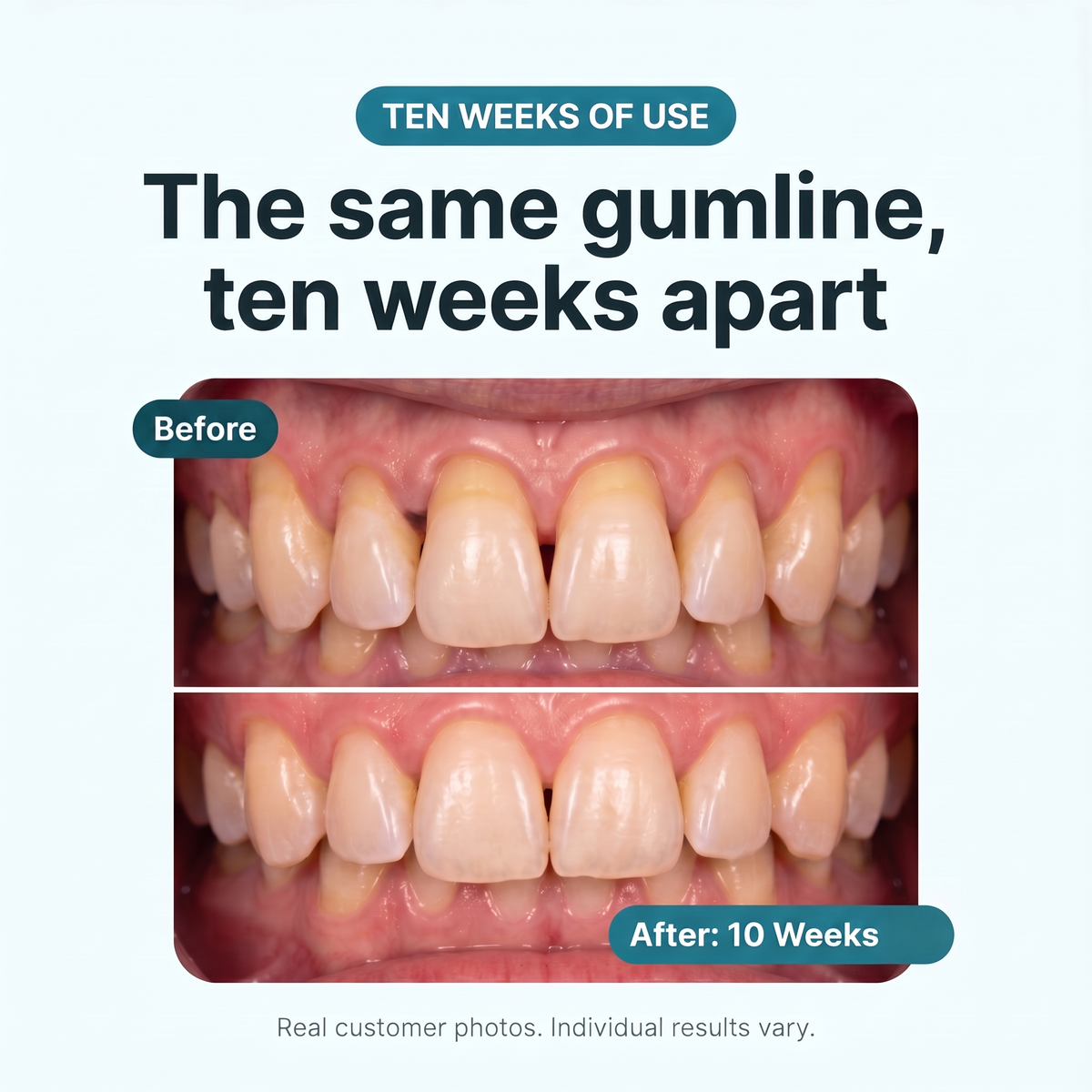 Restore Receding & Damaged Gums - CollaGum™