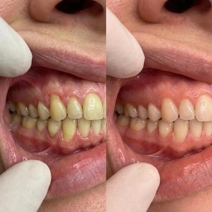 Restore Receding & Damaged Gums - CollaGum™